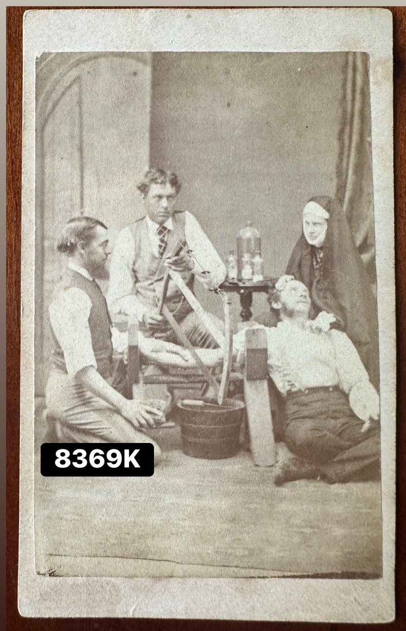 Amputation Antique 1800s Unusual Rare CDV Photo Oddities Canada Amputation Antique 1800s Unusual Rare CDV Photo Oddities Canada